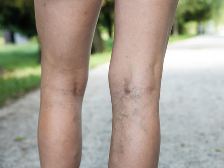 Zorka krém visszér ellen a bőr sötétedésének kezelése visszerekkel